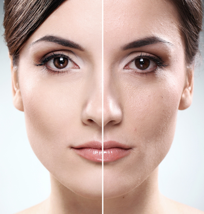 San Francisco Dermatology | Photofacial Skin Rejuvenation | Cosmetic